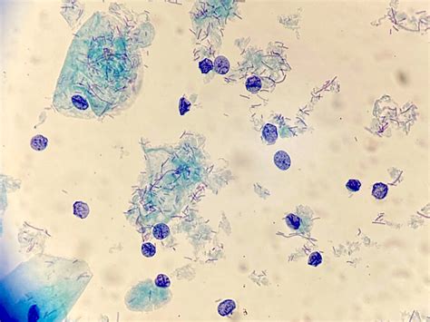 coccobacilli pap test|Bacterial vaginosis: comparison of Pap smear and microbiological .
